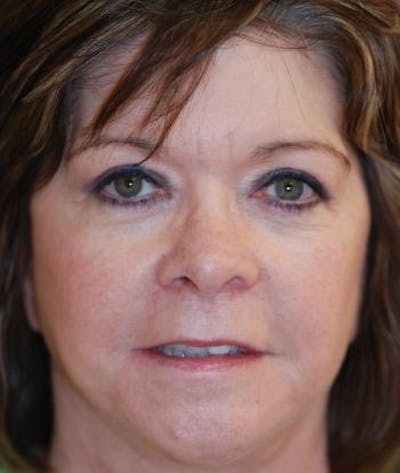 Browlift Before & After Gallery - Patient 315816 - Image 2