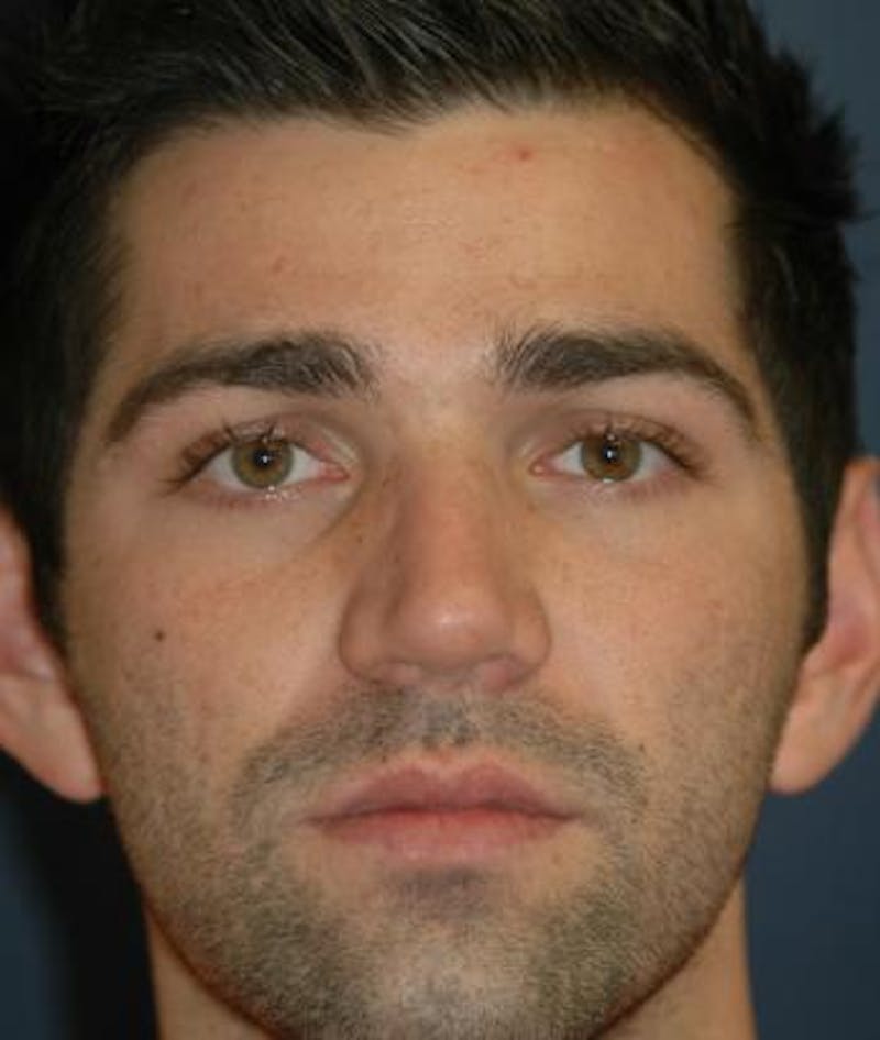 Rhinoplasty Before & After Gallery - Patient 280387 - Image 4