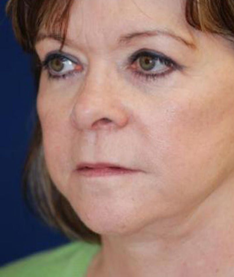 Facelift Before & After Gallery - Patient 333690 - Image 2