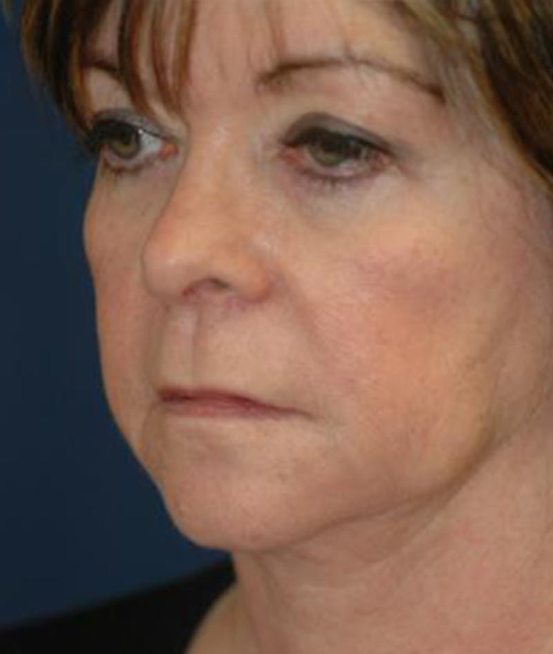 Facelift Before & After Gallery - Patient 333690 - Image 1