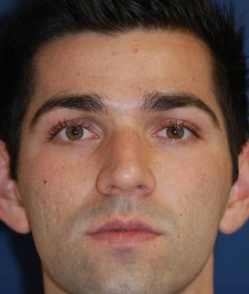 Rhinoplasty Before & After Gallery - Patient 280387 - Image 3