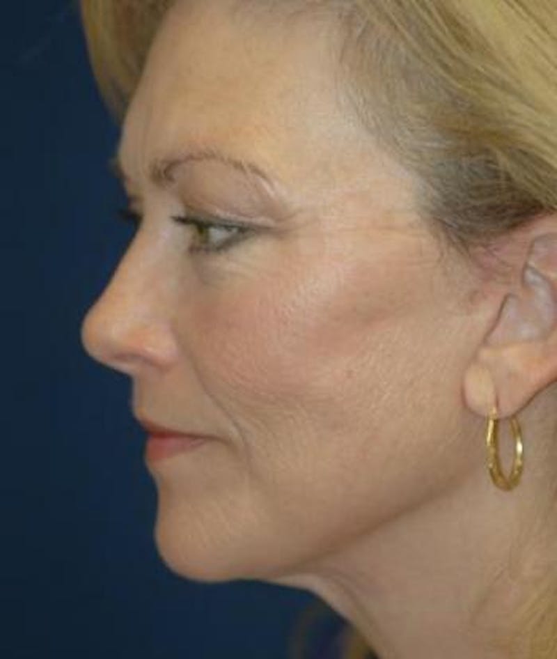 Facelift Before & After Gallery - Patient 413738 - Image 4