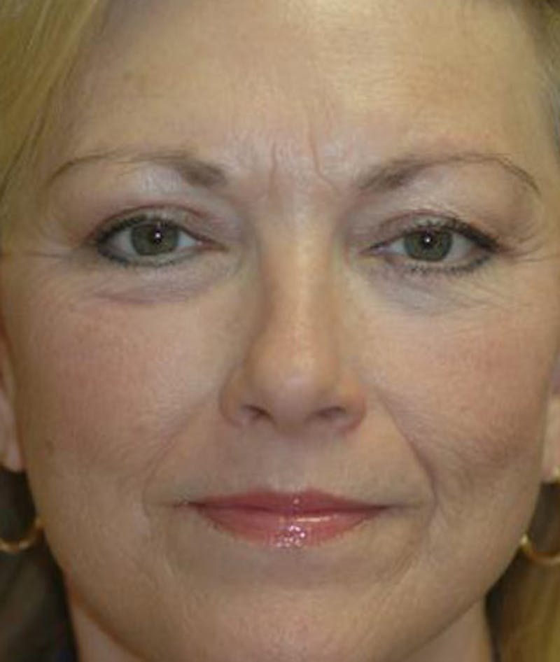 Facelift Before & After Gallery - Patient 413738 - Image 2