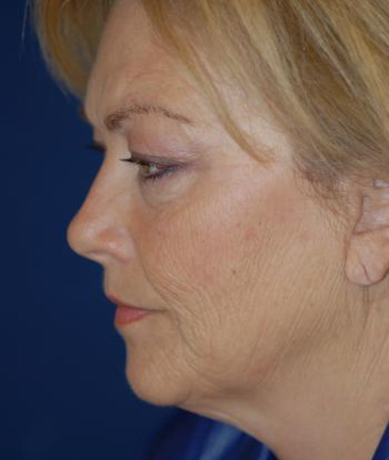 Facelift Before & After Gallery - Patient 413738 - Image 3