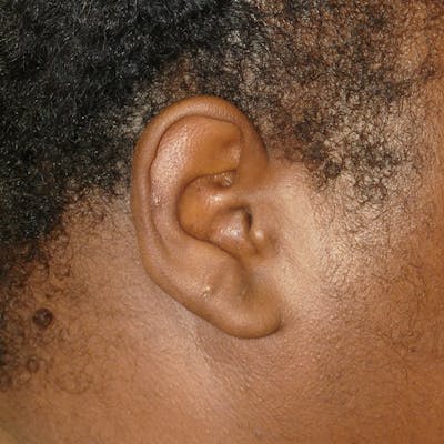 Scars/Malformations Before & After Gallery - Patient 217688 - Image 2