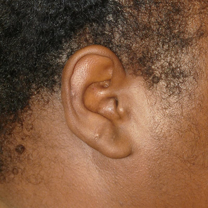 Scars/Malformations Before & After Gallery - Patient 217688 - Image 2