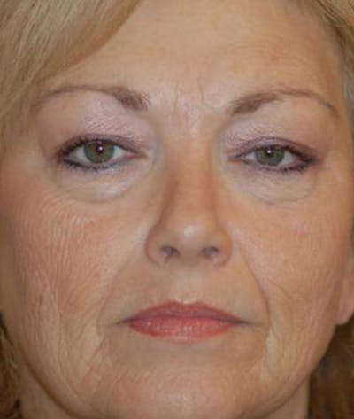 Facelift Before & After Gallery - Patient 413738 - Image 1