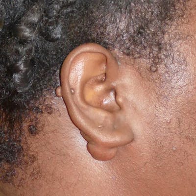 Scars/Malformations Before & After Gallery - Patient 217688 - Image 1