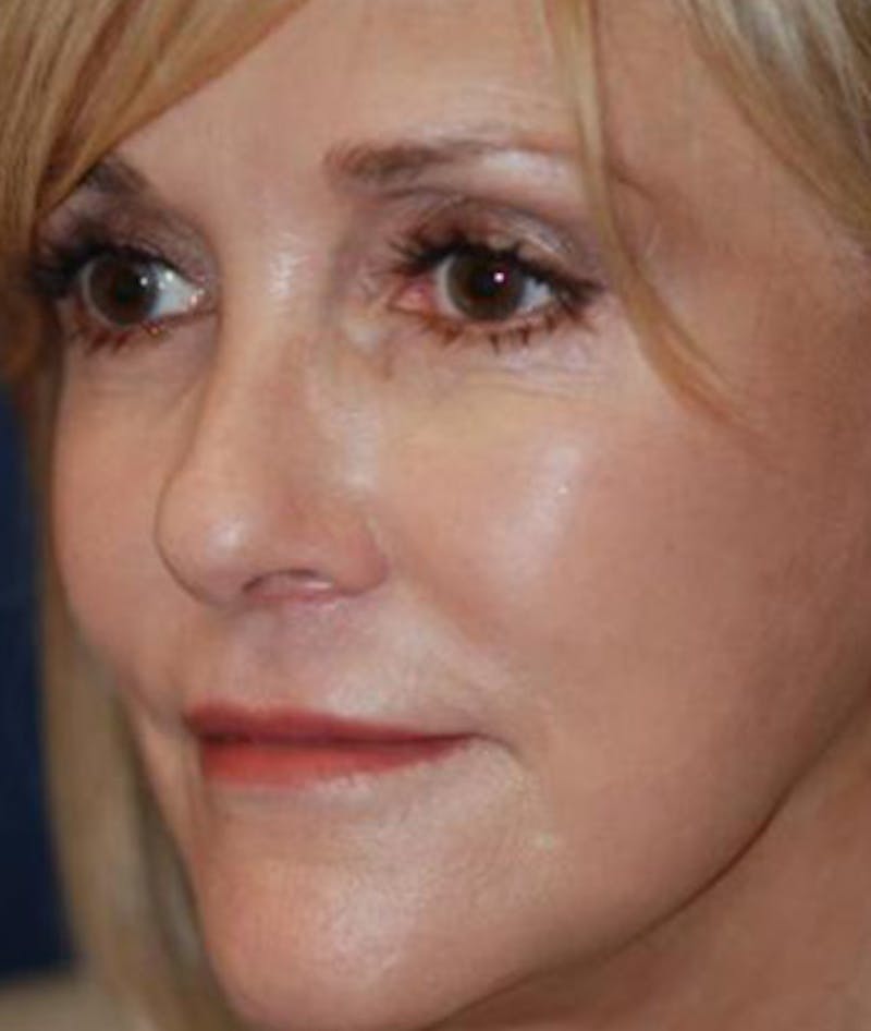 Facelift Before & After Gallery - Patient 792884 - Image 4