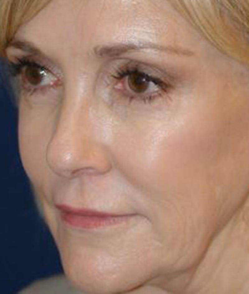 Facelift Before & After Gallery - Patient 792884 - Image 3