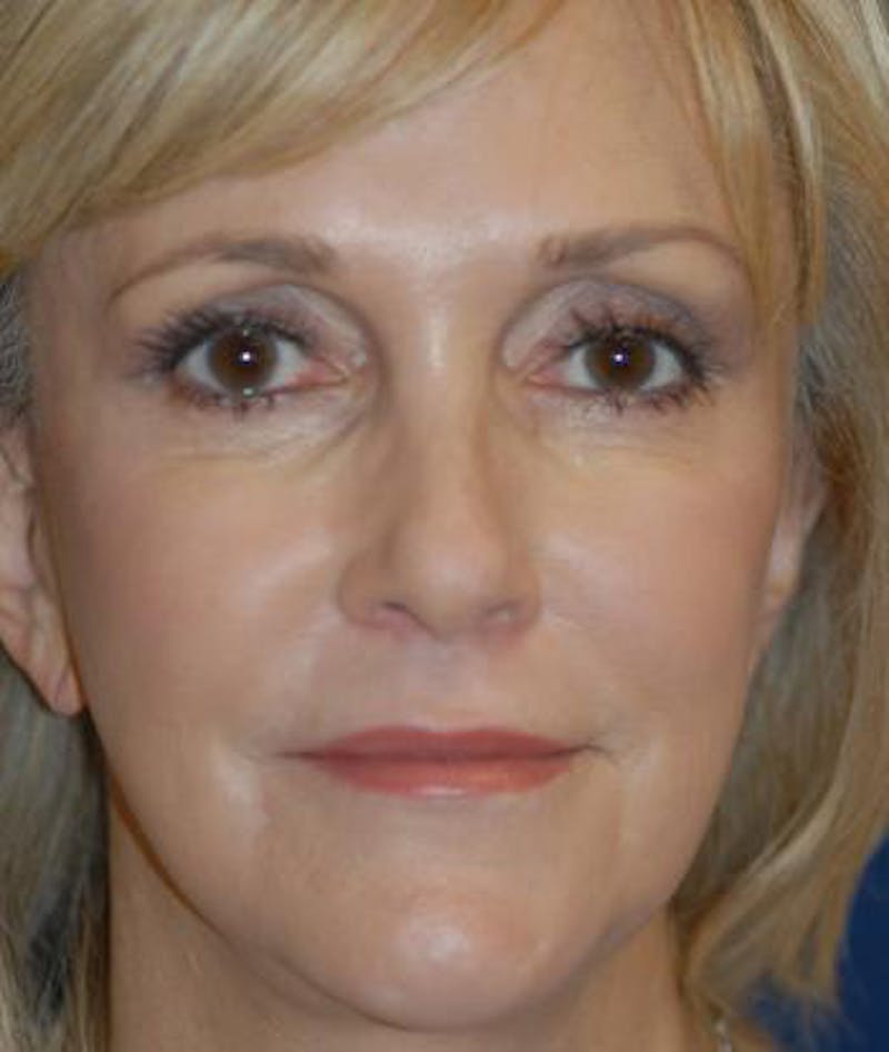 Facelift Before & After Gallery - Patient 792884 - Image 2