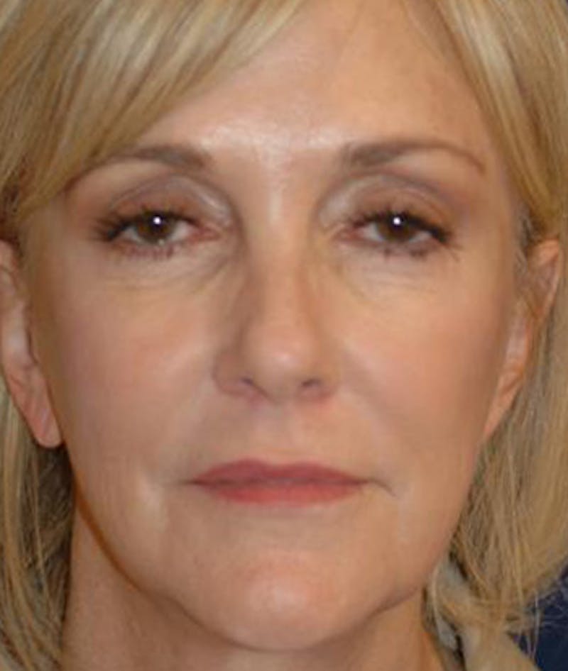 Facelift Before & After Gallery - Patient 792884 - Image 1