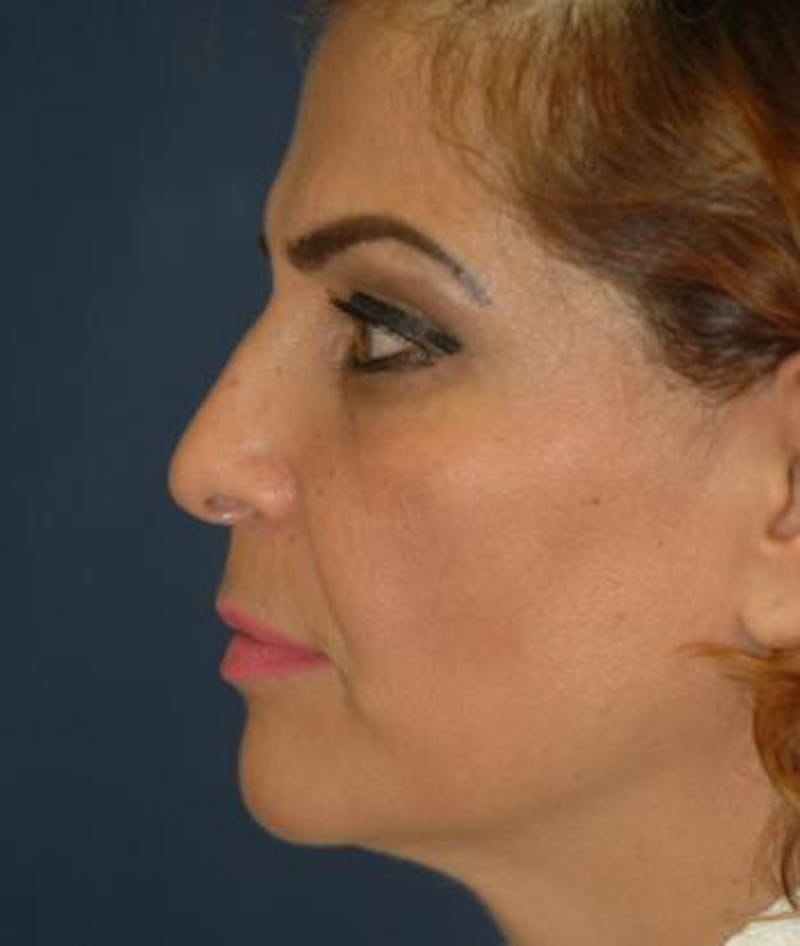 Facelift Before & After Gallery - Patient 157818 - Image 1