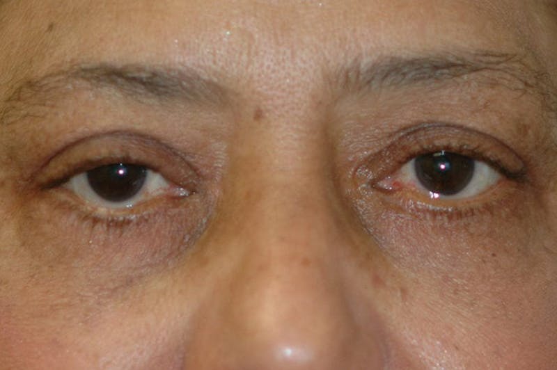 Eyelid Lift (Blepharoplasty) Before & After Gallery - Patient 203234 - Image 4