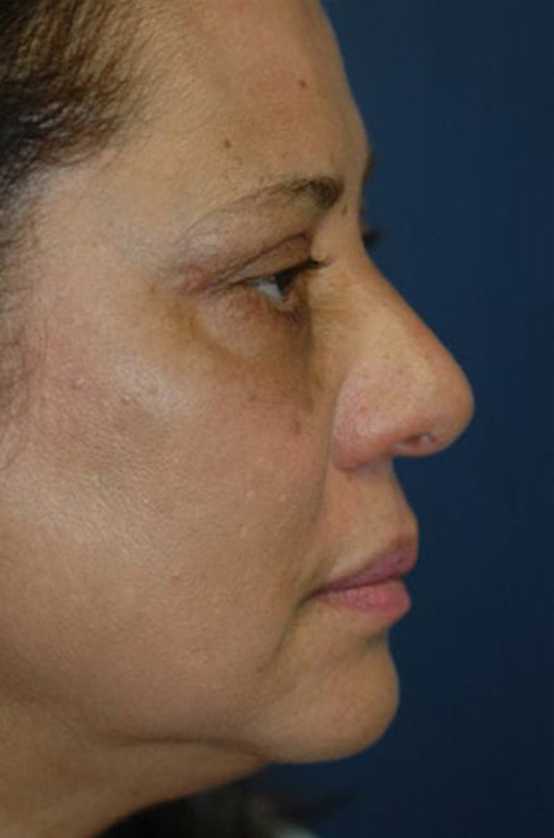 Eyelid Lift (Blepharoplasty) Before & After Gallery - Patient 203234 - Image 2