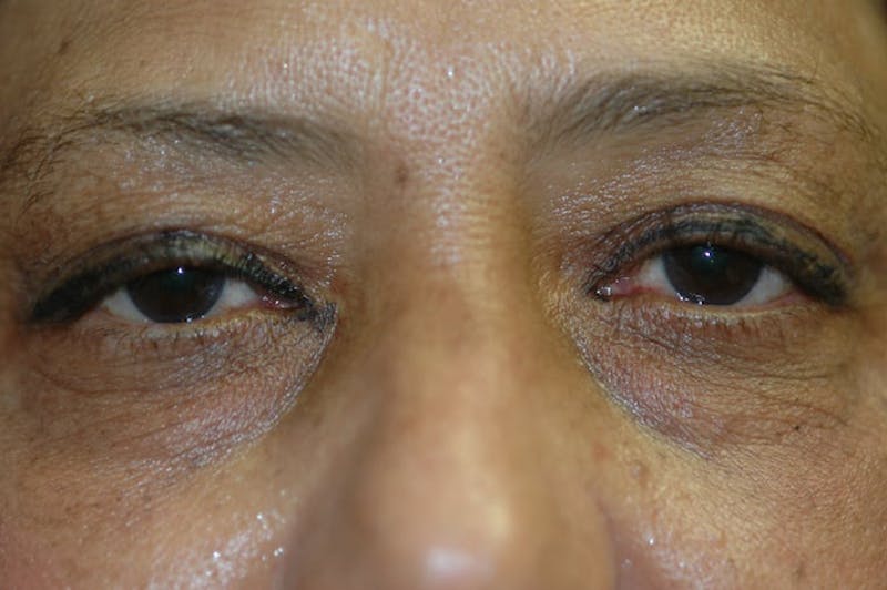 Eyelid Lift (Blepharoplasty) Before & After Gallery - Patient 203234 - Image 3