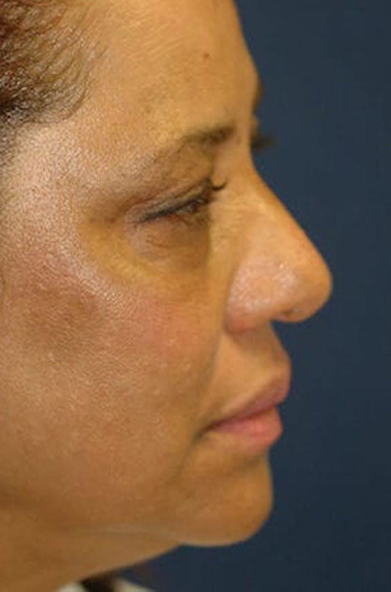 Eyelid Lift (Blepharoplasty) Before & After Gallery - Patient 203234 - Image 1