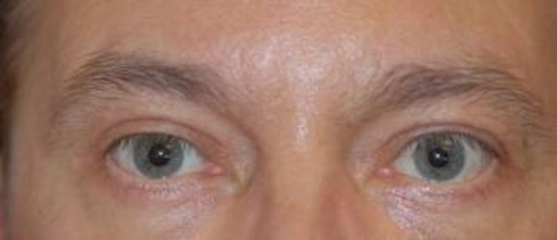 Eyelid Lift (Blepharoplasty) Before & After Gallery - Patient 269620 - Image 4