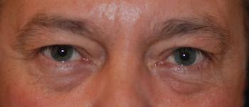 Eyelid Lift (Blepharoplasty) Before & After Gallery - Patient 269620 - Image 3