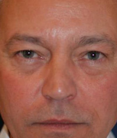 Eyelid Lift (Blepharoplasty) Before & After Gallery - Patient 269620 - Image 1