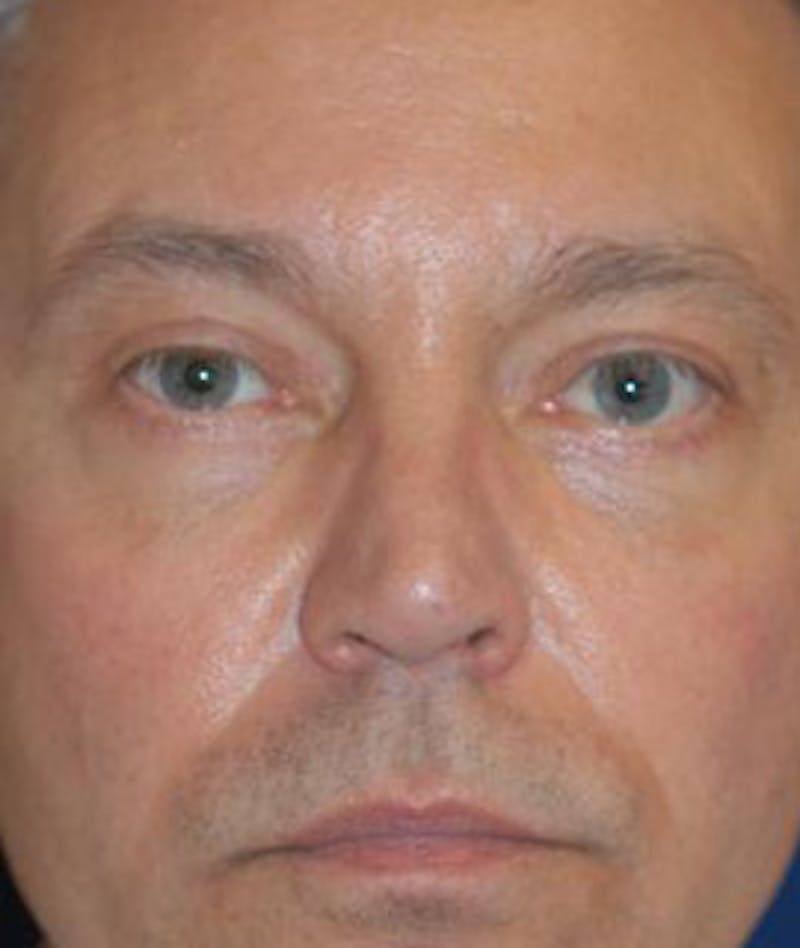 Eyelid Lift (Blepharoplasty) Before & After Gallery - Patient 269620 - Image 2