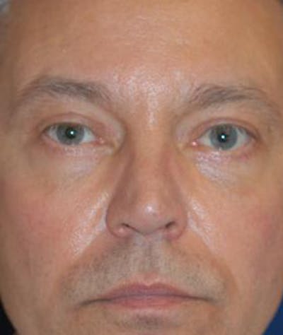 Eyelid Lift (Blepharoplasty) Before & After Gallery - Patient 269620 - Image 2