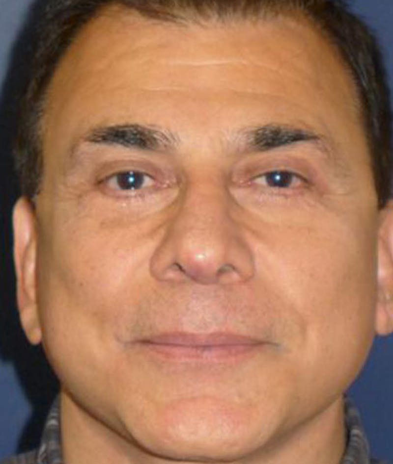 Eyelid Lift (Blepharoplasty) Before & After Gallery - Patient 405504 - Image 2