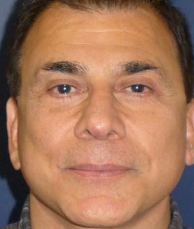 Eyelid Lift (Blepharoplasty) Before & After Gallery - Patient 405504 - Image 2