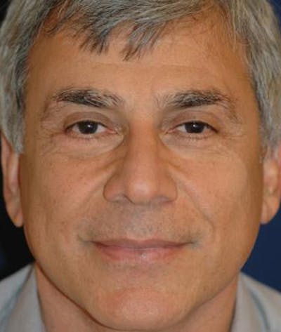 Eyelid Lift (Blepharoplasty) Before & After Gallery - Patient 405504 - Image 1