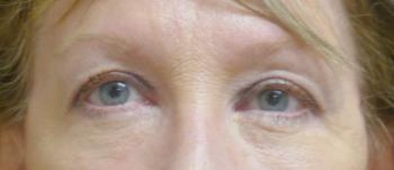 Eyelid Lift (Blepharoplasty) Before & After Gallery - Patient 379970 - Image 2