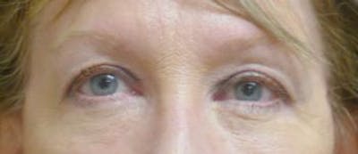 Eyelid Lift (Blepharoplasty) Before & After Gallery - Patient 379970 - Image 2