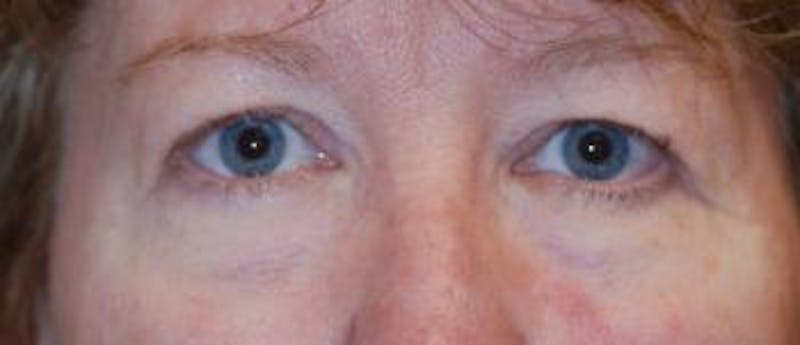 Eyelid Lift (Blepharoplasty) Before & After Gallery - Patient 379970 - Image 1