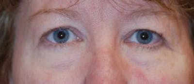 Eyelid Lift (Blepharoplasty) Before & After Gallery - Patient 379970 - Image 1