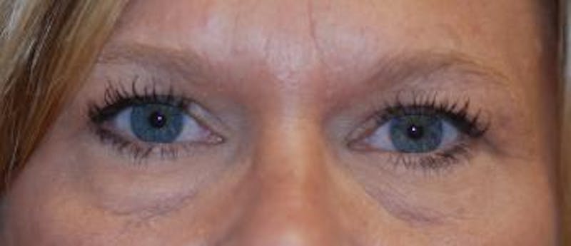 Eyelid Lift (Blepharoplasty) Before & After Gallery - Patient 822685 - Image 3