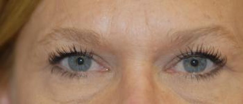 Eyelid Lift (Blepharoplasty) Before & After Gallery - Patient 822685 - Image 4