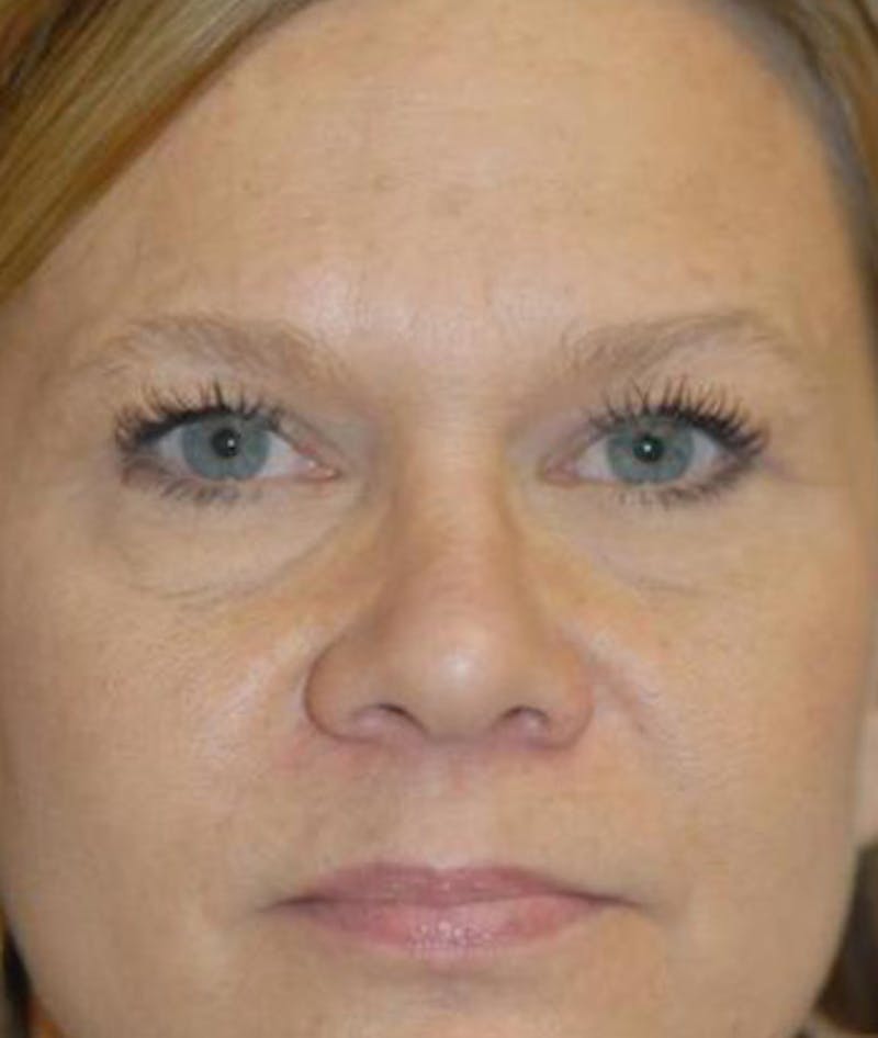 Eyelid Lift (Blepharoplasty) Before & After Gallery - Patient 822685 - Image 2