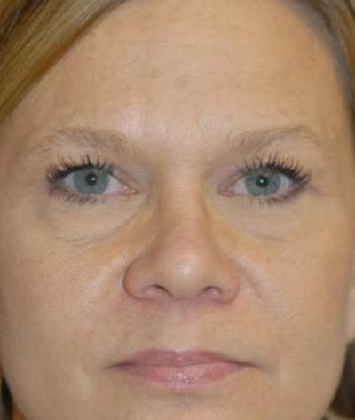 Eyelid Lift (Blepharoplasty) Before & After Gallery - Patient 822685 - Image 2