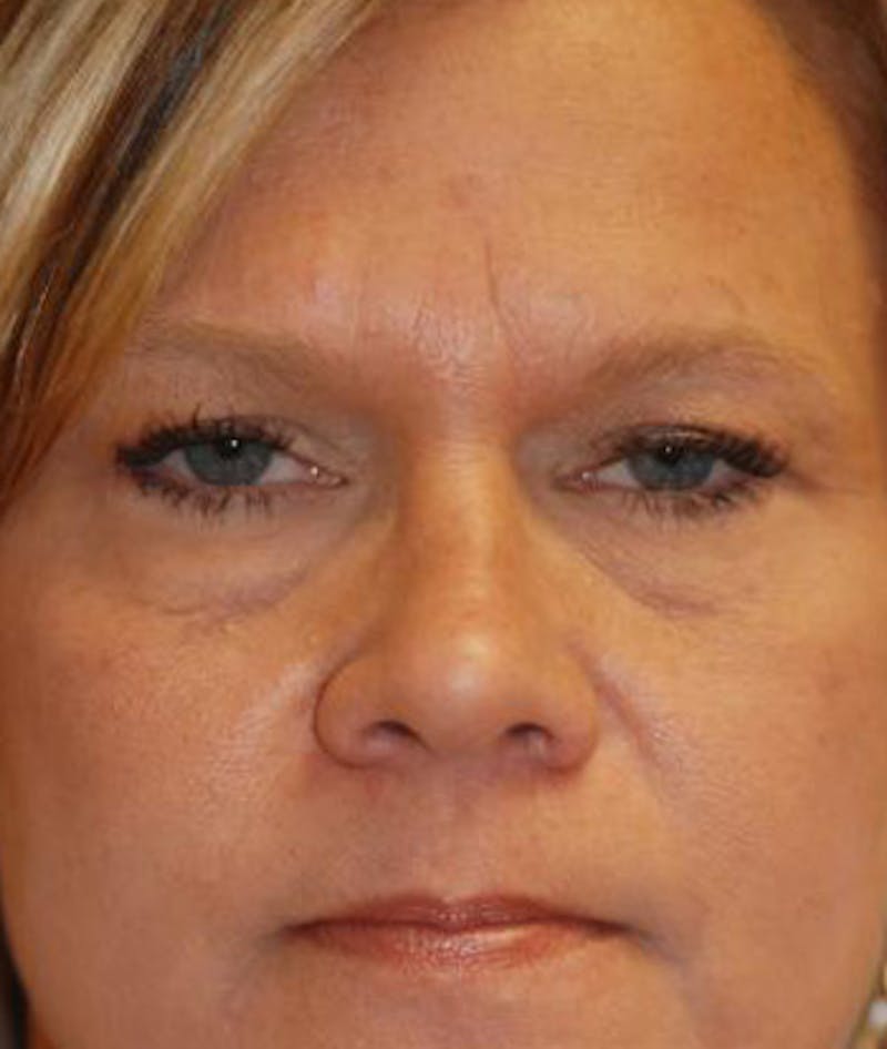 Eyelid Lift (Blepharoplasty) Before & After Gallery - Patient 822685 - Image 1