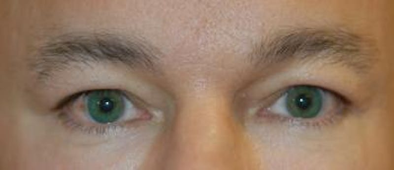 Eyelid Lift (Blepharoplasty) Before & After Gallery - Patient 156649 - Image 3