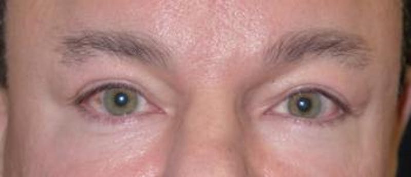 Eyelid Lift (Blepharoplasty) Before & After Gallery - Patient 156649 - Image 4