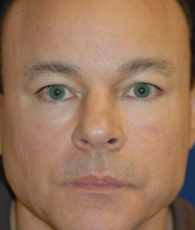Eyelid Lift (Blepharoplasty) Before & After Gallery - Patient 156649 - Image 1