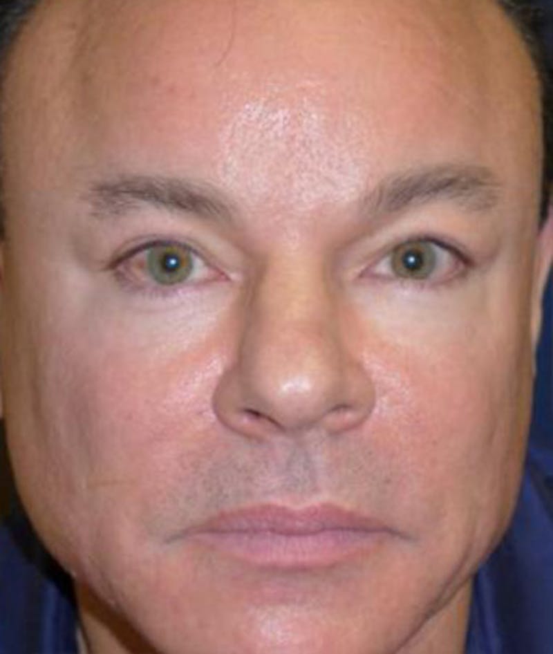 Eyelid Lift (Blepharoplasty) Before & After Gallery - Patient 156649 - Image 2
