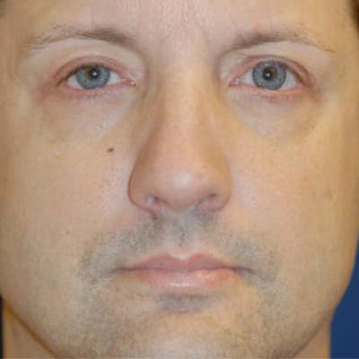 Eyelid Lift (Blepharoplasty) Before & After Gallery - Patient 260500 - Image 2
