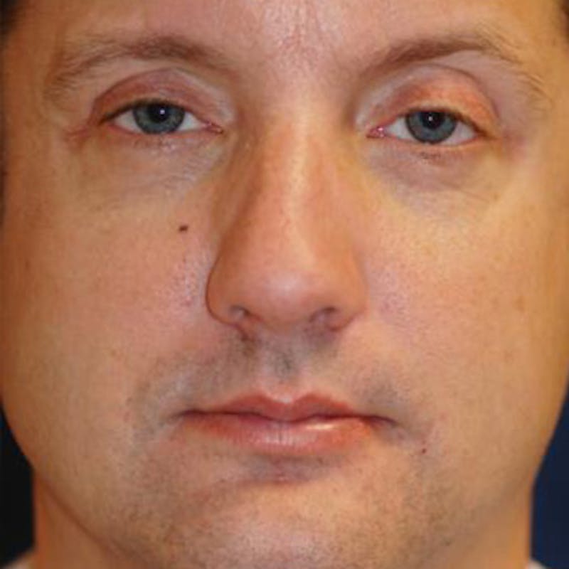 Eyelid Lift (Blepharoplasty) Before & After Gallery - Patient 260500 - Image 1