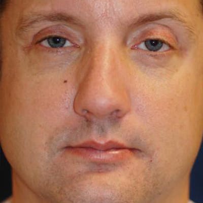 Eyelid Lift (Blepharoplasty) Before & After Gallery - Patient 260500 - Image 1