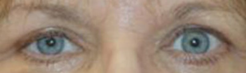 Browlift Before & After Gallery - Patient 239688 - Image 4