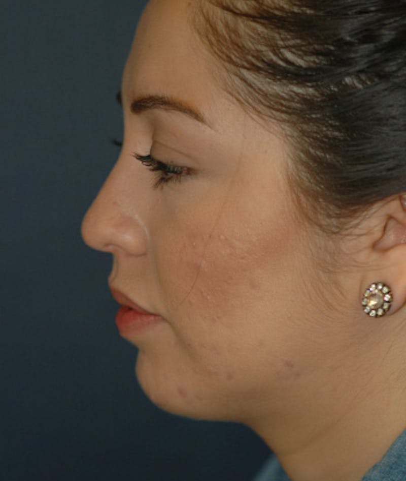 Chin Augmentation Before & After Gallery - Patient 156883 - Image 8