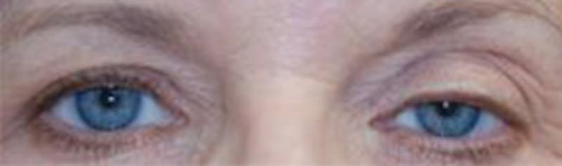 Browlift Before & After Gallery - Patient 239688 - Image 3