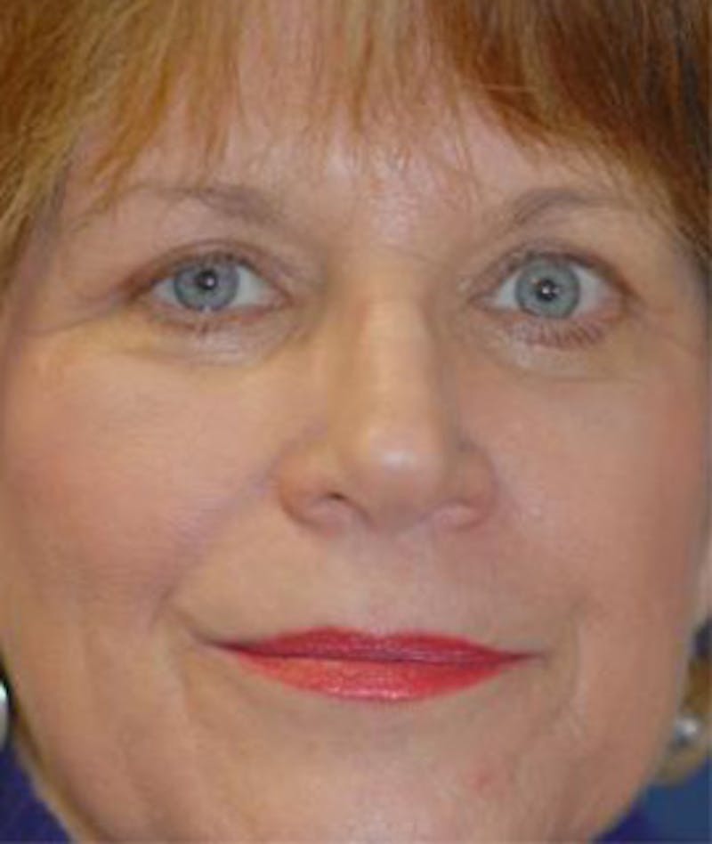 Browlift Before & After Gallery - Patient 239688 - Image 2