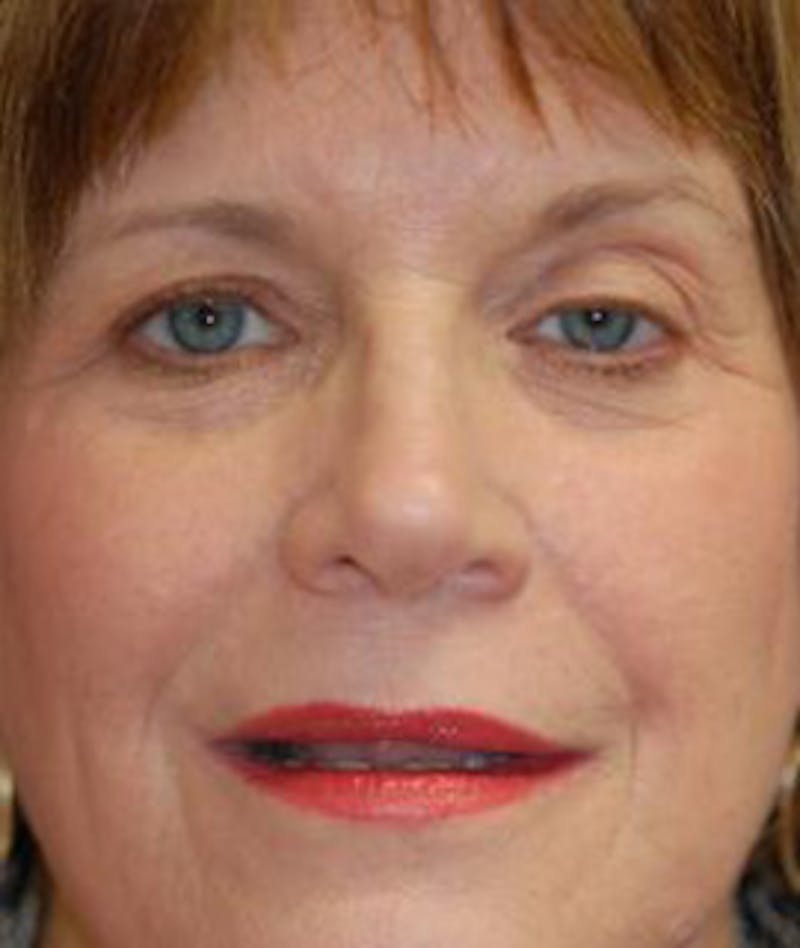 Browlift Before & After Gallery - Patient 239688 - Image 1